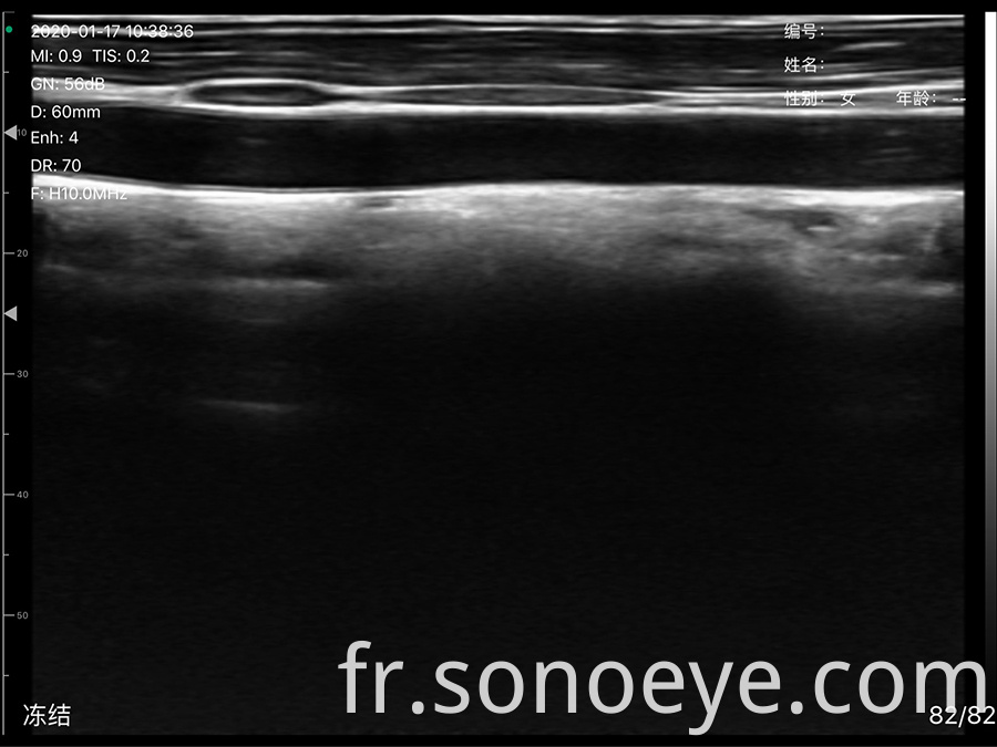 Super Width Linear Probe Type Wireless Mini Ultrasound